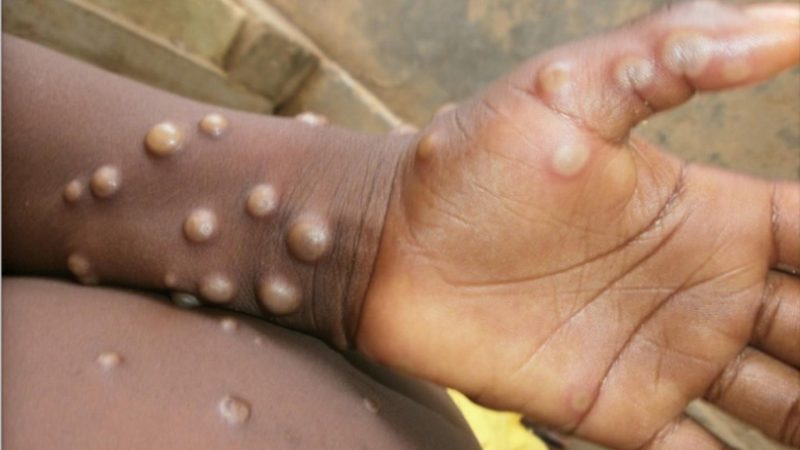 OMS recunoaşte că focarul actual de variola maimuţei este extrem de neobişnuit